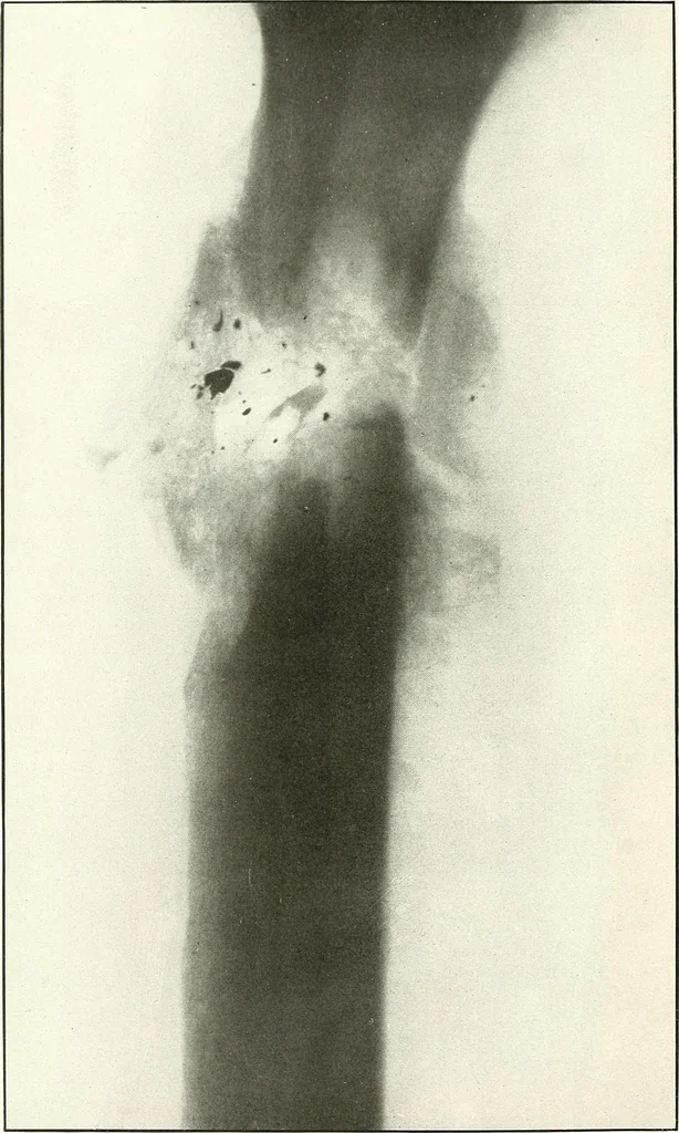 An illustration from Gunshot Roentgenograms : Acollection of Roentgenograms taken in Constantinople during the Turko-Balkan War, 1912-1913, illustrating some gunshot wounds in the Turkish Army, 1916, leaf 288