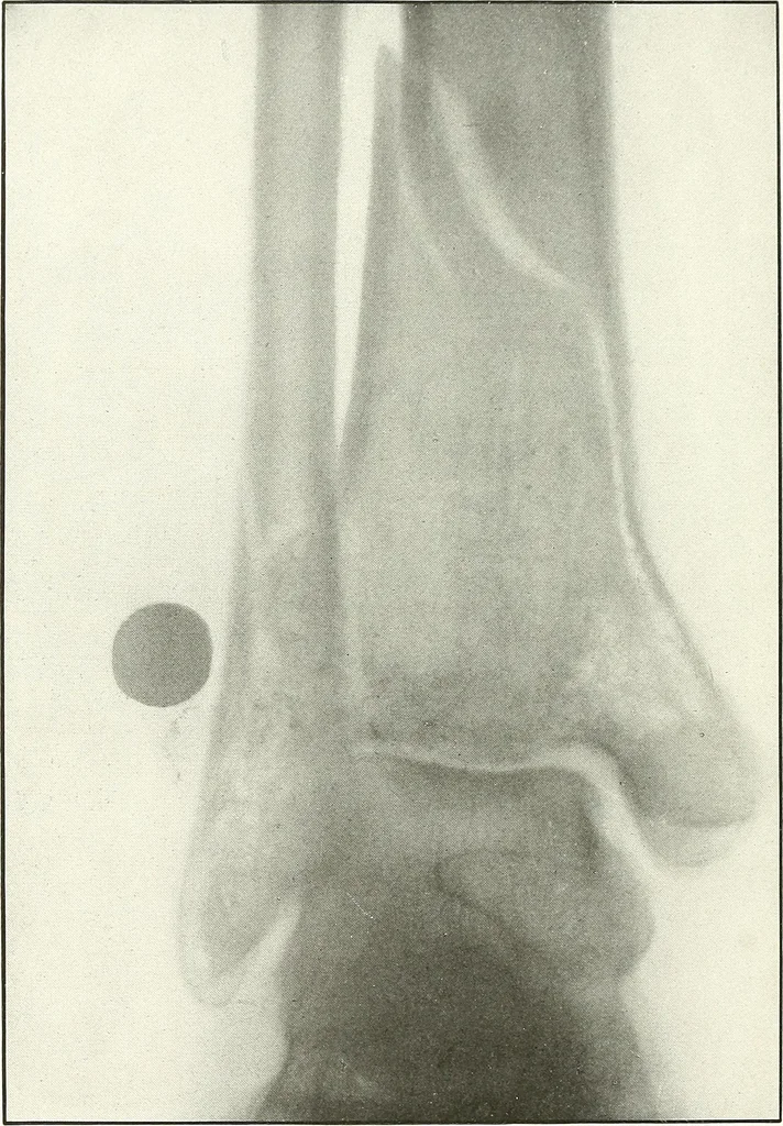 An illustration from Gunshot Roentgenograms : Acollection of Roentgenograms taken in Constantinople during the Turko-Balkan War, 1912-1913, illustrating some gunshot wounds in the Turkish Army, 1916, leaf 294