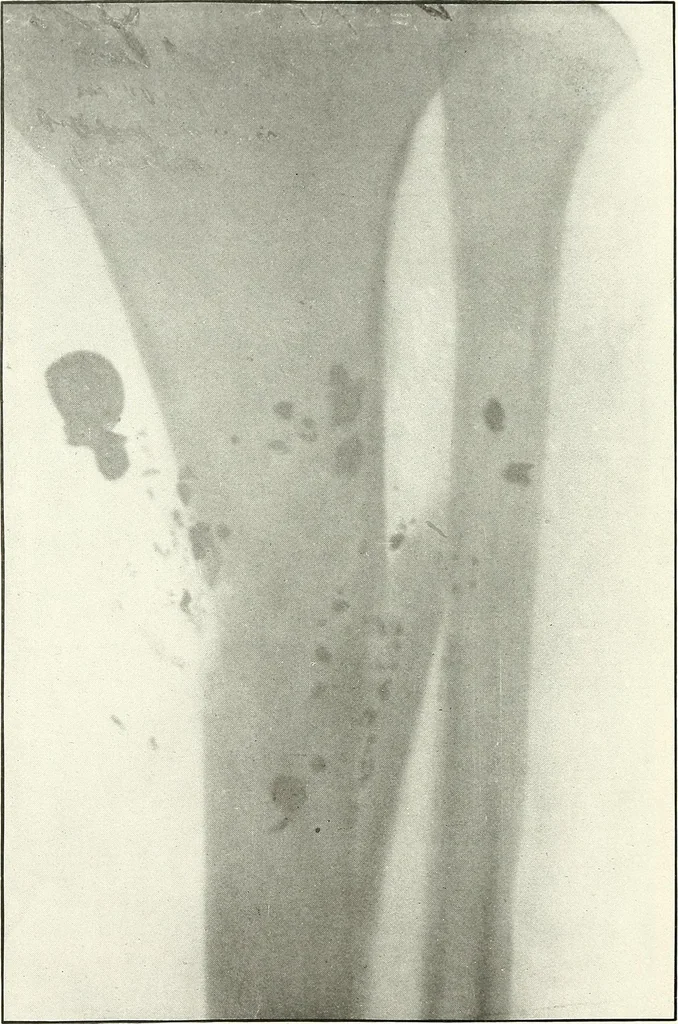 An illustration from Gunshot Roentgenograms : Acollection of Roentgenograms taken in Constantinople during the Turko-Balkan War, 1912-1913, illustrating some gunshot wounds in the Turkish Army, 1916, leaf 296