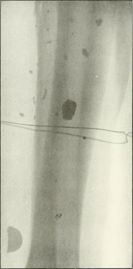 An illustration from Gunshot Roentgenograms : Acollection of Roentgenograms taken in Constantinople during the Turko-Balkan War, 1912-1913, illustrating some gunshot wounds in the Turkish Army, 1916, leaf 298