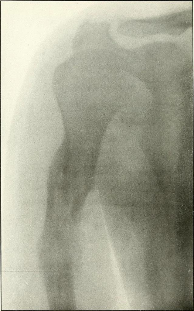 An illustration from Gunshot Roentgenograms : Acollection of Roentgenograms taken in Constantinople during the Turko-Balkan War, 1912-1913, illustrating some gunshot wounds in the Turkish Army, 1916, leaf 30
