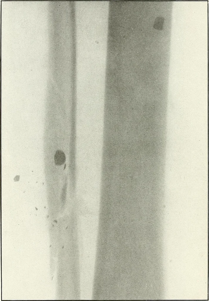 An illustration from Gunshot Roentgenograms : Acollection of Roentgenograms taken in Constantinople during the Turko-Balkan War, 1912-1913, illustrating some gunshot wounds in the Turkish Army, 1916, leaf 300