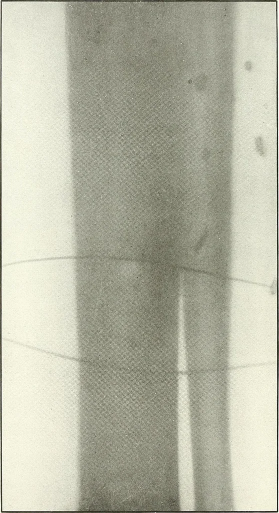 An illustration from Gunshot Roentgenograms : Acollection of Roentgenograms taken in Constantinople during the Turko-Balkan War, 1912-1913, illustrating some gunshot wounds in the Turkish Army, 1916, leaf 302