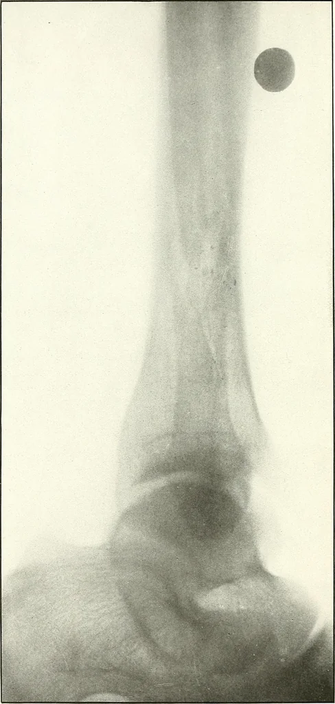 An illustration from Gunshot Roentgenograms : Acollection of Roentgenograms taken in Constantinople during the Turko-Balkan War, 1912-1913, illustrating some gunshot wounds in the Turkish Army, 1916, leaf 304