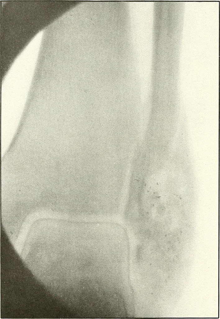 An illustration from Gunshot Roentgenograms : Acollection of Roentgenograms taken in Constantinople during the Turko-Balkan War, 1912-1913, illustrating some gunshot wounds in the Turkish Army, 1916, leaf 308