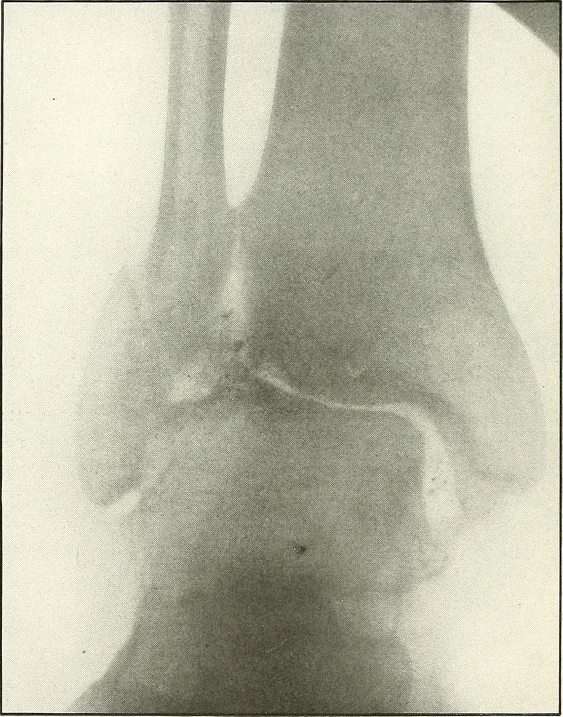An illustration from Gunshot Roentgenograms : Acollection of Roentgenograms taken in Constantinople during the Turko-Balkan War, 1912-1913, illustrating some gunshot wounds in the Turkish Army, 1916, leaf 310