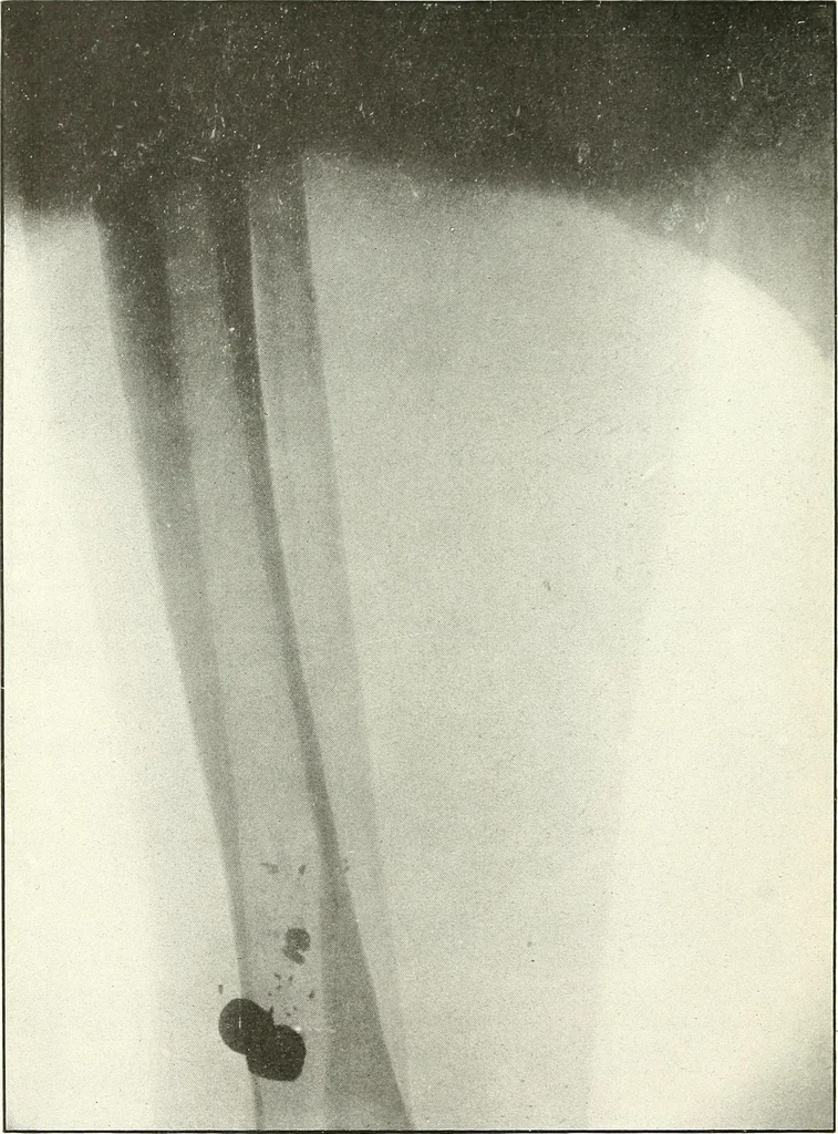 An illustration from Gunshot Roentgenograms : Acollection of Roentgenograms taken in Constantinople during the Turko-Balkan War, 1912-1913, illustrating some gunshot wounds in the Turkish Army, 1916, leaf 312