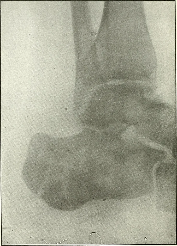An illustration from Gunshot Roentgenograms : Acollection of Roentgenograms taken in Constantinople during the Turko-Balkan War, 1912-1913, illustrating some gunshot wounds in the Turkish Army, 1916, leaf 316