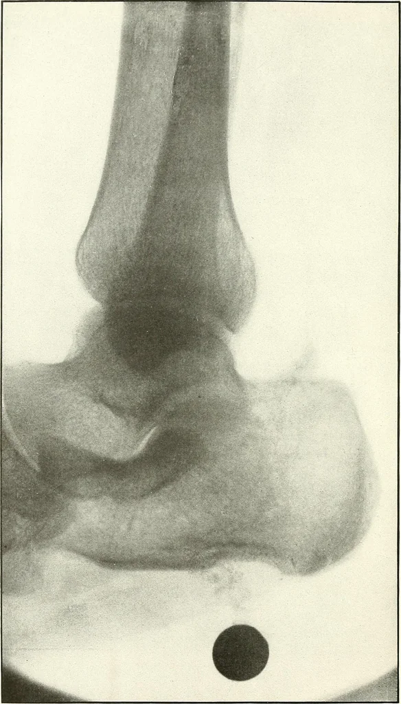 An illustration from Gunshot Roentgenograms : Acollection of Roentgenograms taken in Constantinople during the Turko-Balkan War, 1912-1913, illustrating some gunshot wounds in the Turkish Army, 1916, leaf 318