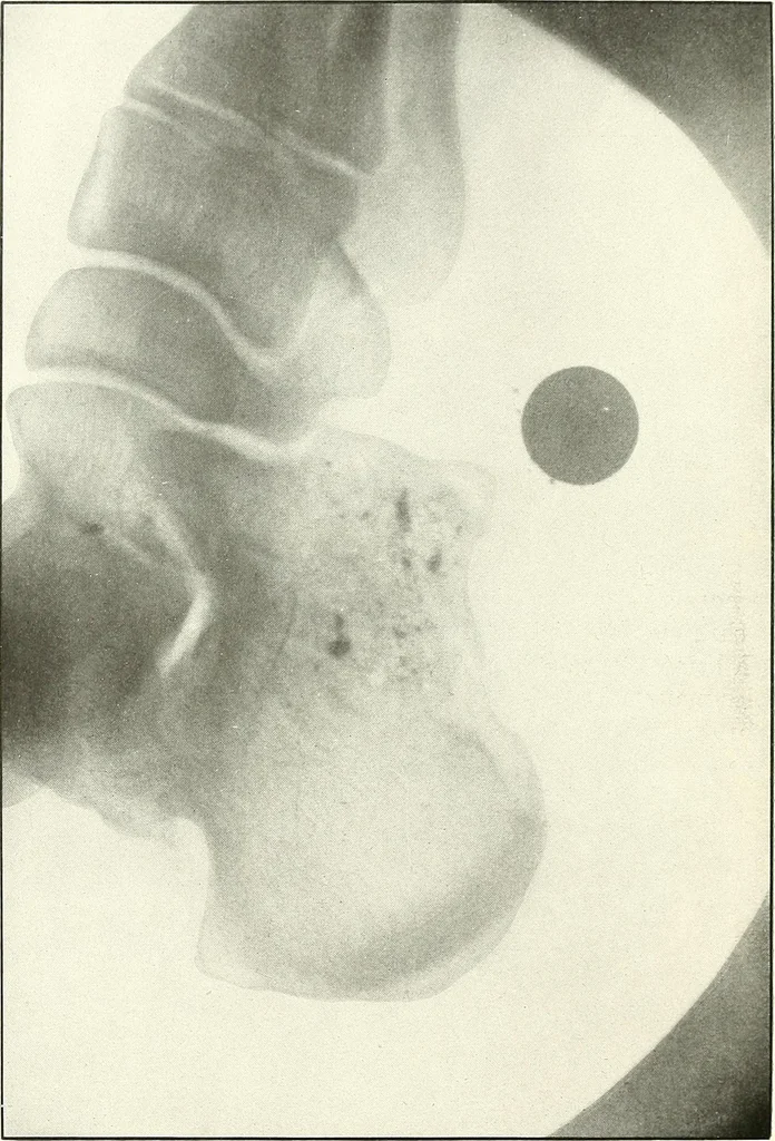 An illustration from Gunshot Roentgenograms : Acollection of Roentgenograms taken in Constantinople during the Turko-Balkan War, 1912-1913, illustrating some gunshot wounds in the Turkish Army, 1916, leaf 320