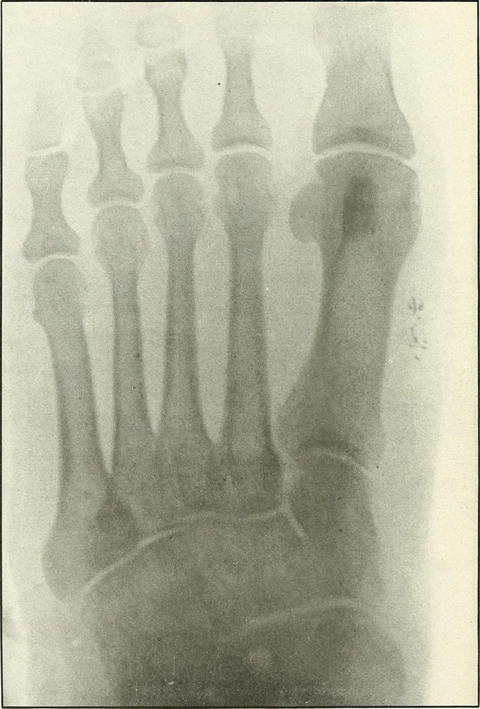 An illustration from Gunshot Roentgenograms : Acollection of Roentgenograms taken in Constantinople during the Turko-Balkan War, 1912-1913, illustrating some gunshot wounds in the Turkish Army, 1916, leaf 322