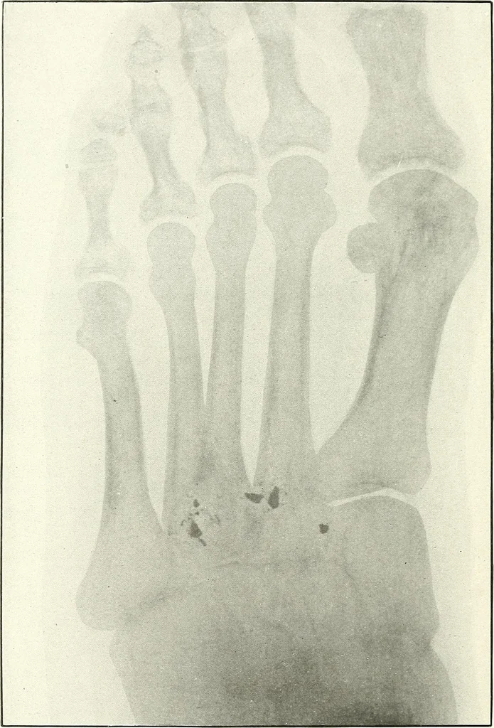 An illustration from Gunshot Roentgenograms : Acollection of Roentgenograms taken in Constantinople during the Turko-Balkan War, 1912-1913, illustrating some gunshot wounds in the Turkish Army, 1916, leaf 324