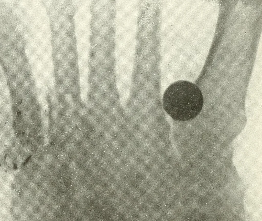An illustration from Gunshot Roentgenograms : Acollection of Roentgenograms taken in Constantinople during the Turko-Balkan War, 1912-1913, illustrating some gunshot wounds in the Turkish Army, 1916, leaf 326