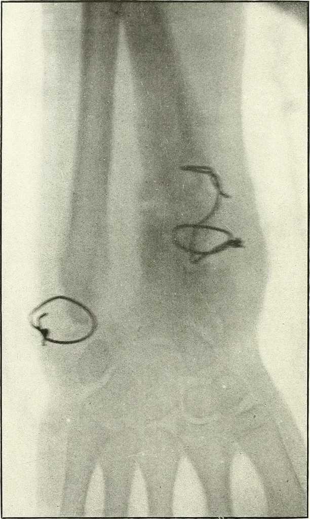 An illustration from Gunshot Roentgenograms : Acollection of Roentgenograms taken in Constantinople during the Turko-Balkan War, 1912-1913, illustrating some gunshot wounds in the Turkish Army, 1916, leaf 332