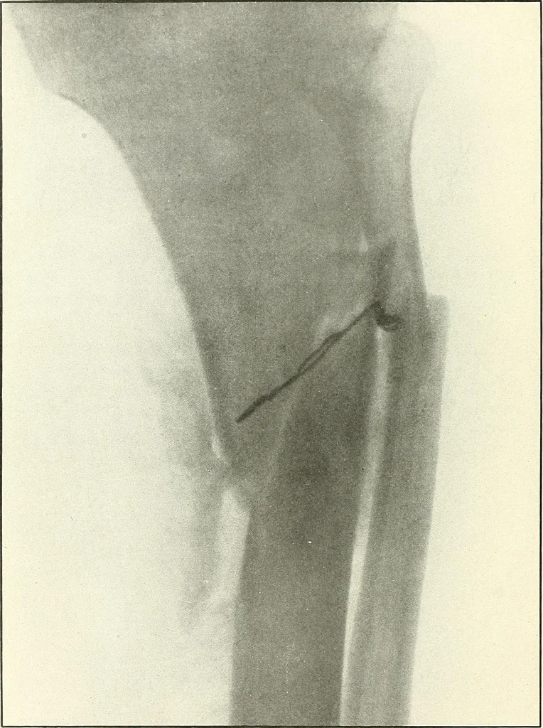 An illustration from Gunshot Roentgenograms : Acollection of Roentgenograms taken in Constantinople during the Turko-Balkan War, 1912-1913, illustrating some gunshot wounds in the Turkish Army, 1916, leaf 334