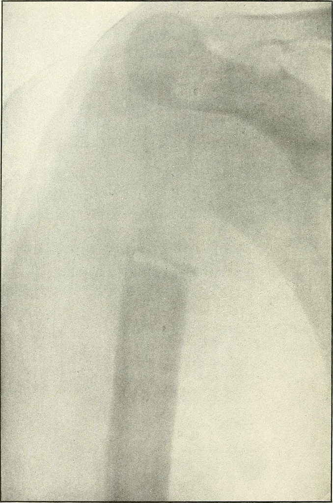 An illustration from Gunshot Roentgenograms : Acollection of Roentgenograms taken in Constantinople during the Turko-Balkan War, 1912-1913, illustrating some gunshot wounds in the Turkish Army, 1916, leaf 338