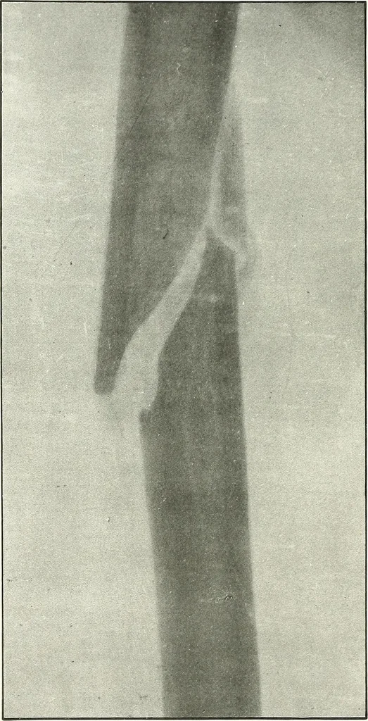 An illustration from Gunshot Roentgenograms : Acollection of Roentgenograms taken in Constantinople during the Turko-Balkan War, 1912-1913, illustrating some gunshot wounds in the Turkish Army, 1916, leaf 38