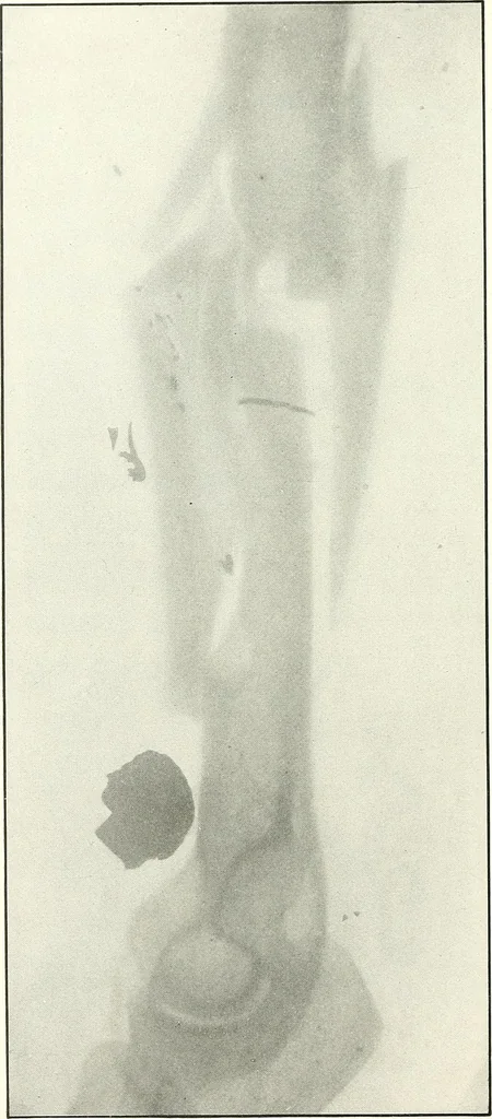 An illustration from Gunshot Roentgenograms : Acollection of Roentgenograms taken in Constantinople during the Turko-Balkan War, 1912-1913, illustrating some gunshot wounds in the Turkish Army, 1916, leaf 40