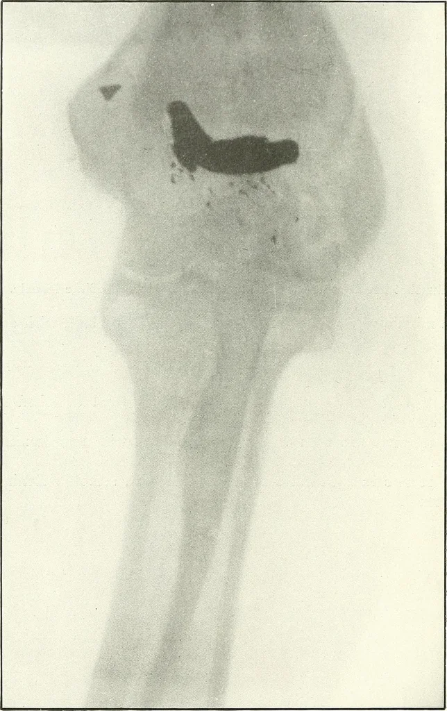 An illustration from Gunshot Roentgenograms : Acollection of Roentgenograms taken in Constantinople during the Turko-Balkan War, 1912-1913, illustrating some gunshot wounds in the Turkish Army, 1916, leaf 44