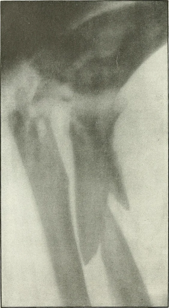 An illustration from Gunshot Roentgenograms : Acollection of Roentgenograms taken in Constantinople during the Turko-Balkan War, 1912-1913, illustrating some gunshot wounds in the Turkish Army, 1916, leaf 48