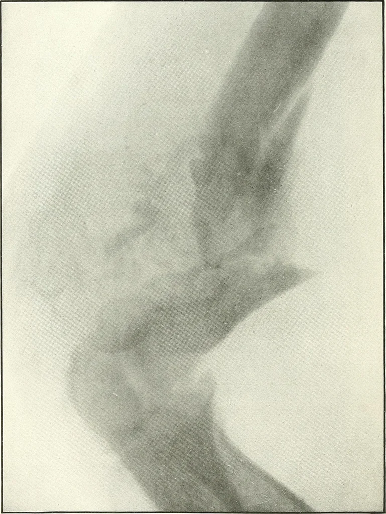 An illustration from Gunshot Roentgenograms : Acollection of Roentgenograms taken in Constantinople during the Turko-Balkan War, 1912-1913, illustrating some gunshot wounds in the Turkish Army, 1916, leaf 50