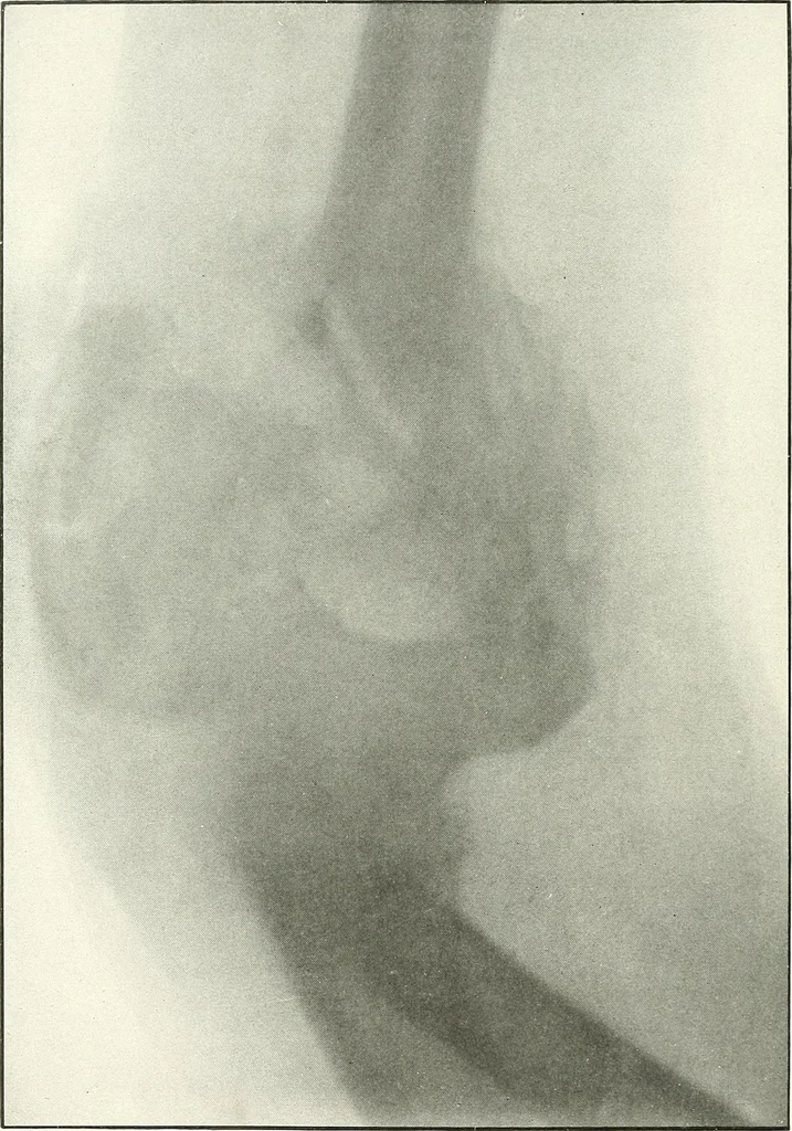 An illustration from Gunshot Roentgenograms : Acollection of Roentgenograms taken in Constantinople during the Turko-Balkan War, 1912-1913, illustrating some gunshot wounds in the Turkish Army, 1916, leaf 52