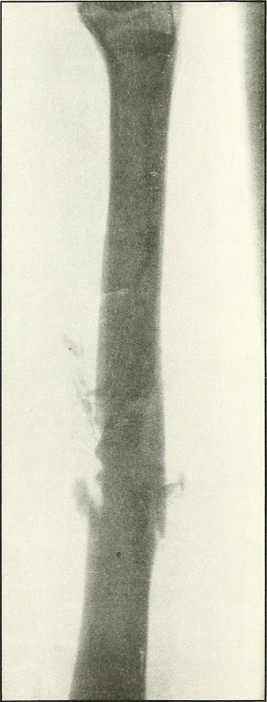 An illustration from Gunshot Roentgenograms : Acollection of Roentgenograms taken in Constantinople during the Turko-Balkan War, 1912-1913, illustrating some gunshot wounds in the Turkish Army, 1916, leaf 64