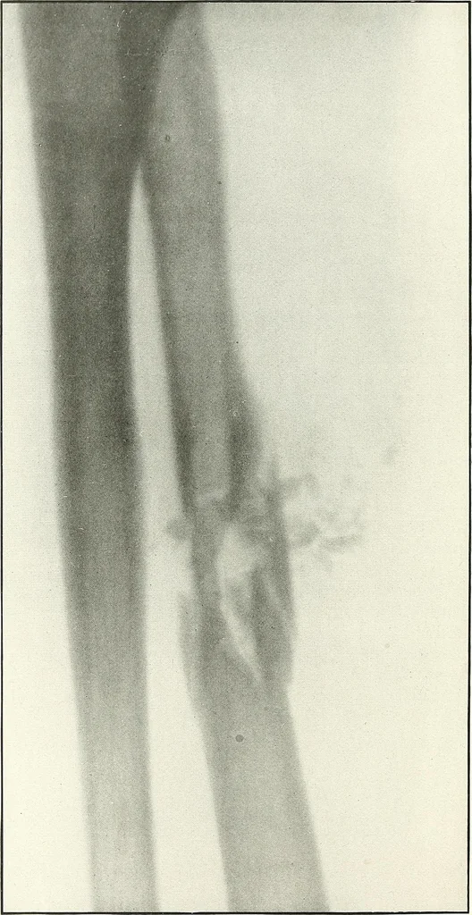 An illustration from Gunshot Roentgenograms : Acollection of Roentgenograms taken in Constantinople during the Turko-Balkan War, 1912-1913, illustrating some gunshot wounds in the Turkish Army, 1916, leaf 66