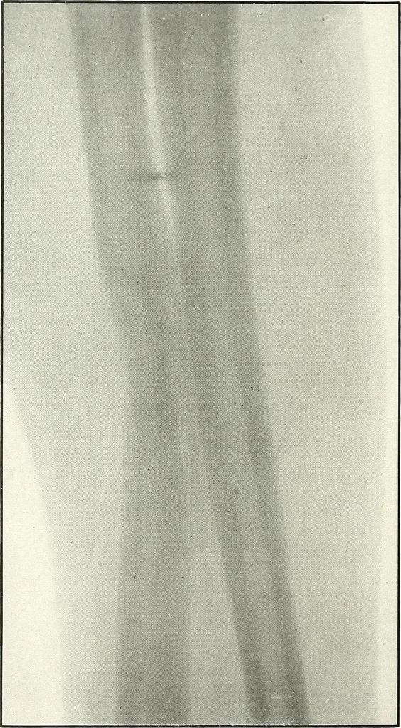An illustration from Gunshot Roentgenograms : Acollection of Roentgenograms taken in Constantinople during the Turko-Balkan War, 1912-1913, illustrating some gunshot wounds in the Turkish Army, 1916, leaf 68