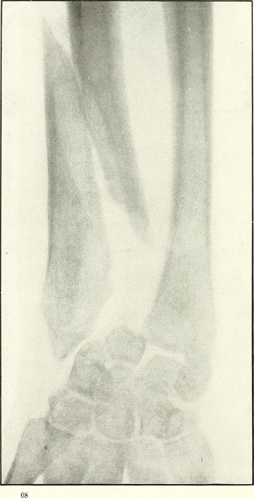 An illustration from Gunshot Roentgenograms : Acollection of Roentgenograms taken in Constantinople during the Turko-Balkan War, 1912-1913, illustrating some gunshot wounds in the Turkish Army, 1916, leaf 72