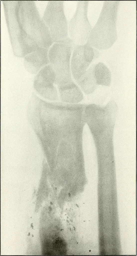 An illustration from Gunshot Roentgenograms : Acollection of Roentgenograms taken in Constantinople during the Turko-Balkan War, 1912-1913, illustrating some gunshot wounds in the Turkish Army, 1916, leaf 74