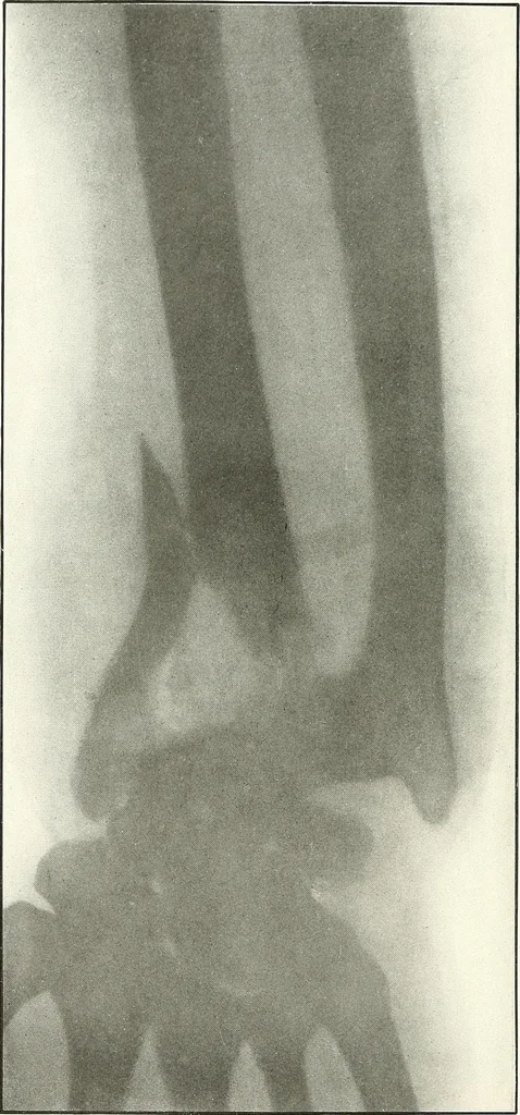 An illustration from Gunshot Roentgenograms : Acollection of Roentgenograms taken in Constantinople during the Turko-Balkan War, 1912-1913, illustrating some gunshot wounds in the Turkish Army, 1916, leaf 76