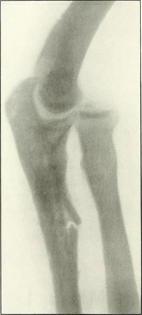 An illustration from Gunshot Roentgenograms : Acollection of Roentgenograms taken in Constantinople during the Turko-Balkan War, 1912-1913, illustrating some gunshot wounds in the Turkish Army, 1916, leaf 78