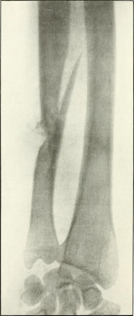 An illustration from Gunshot Roentgenograms : Acollection of Roentgenograms taken in Constantinople during the Turko-Balkan War, 1912-1913, illustrating some gunshot wounds in the Turkish Army, 1916, leaf 84