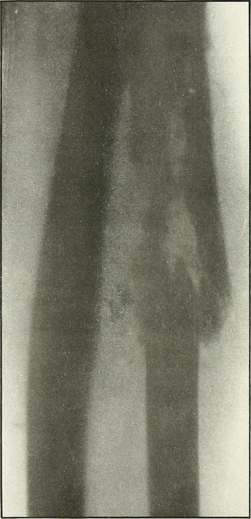 An illustration from Gunshot Roentgenograms : Acollection of Roentgenograms taken in Constantinople during the Turko-Balkan War, 1912-1913, illustrating some gunshot wounds in the Turkish Army, 1916, leaf 86