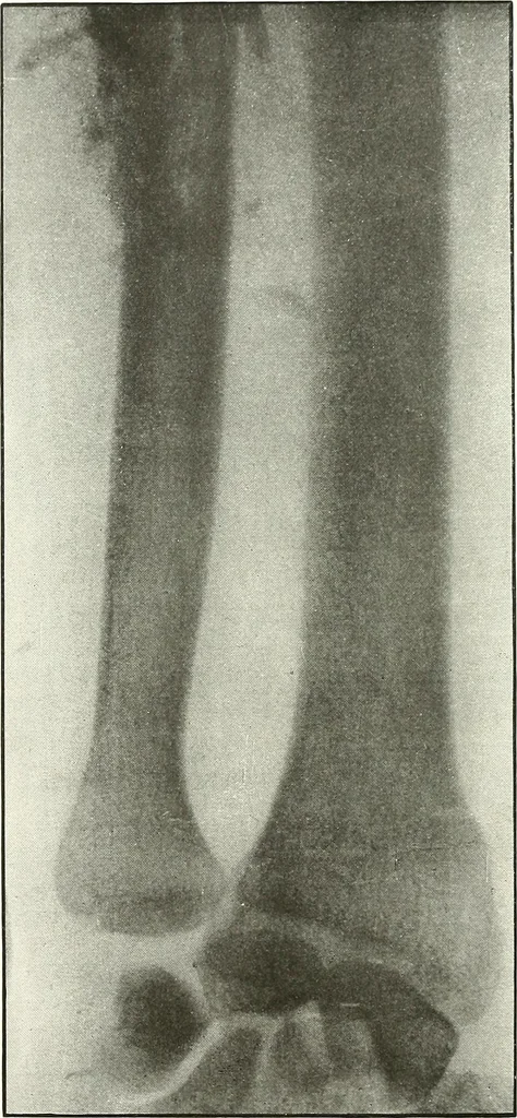 An illustration from Gunshot Roentgenograms : Acollection of Roentgenograms taken in Constantinople during the Turko-Balkan War, 1912-1913, illustrating some gunshot wounds in the Turkish Army, 1916, leaf 90