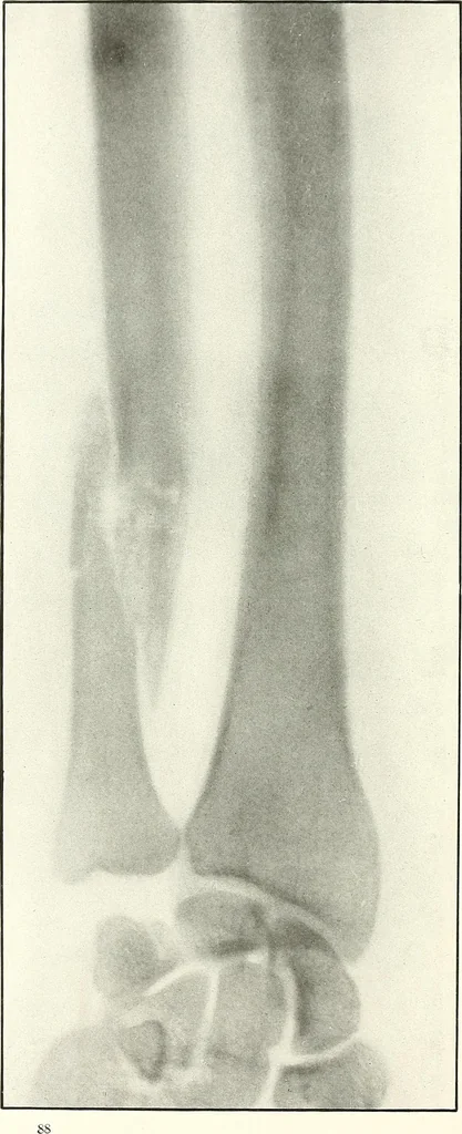 An illustration from Gunshot Roentgenograms : Acollection of Roentgenograms taken in Constantinople during the Turko-Balkan War, 1912-1913, illustrating some gunshot wounds in the Turkish Army, 1916, leaf 92