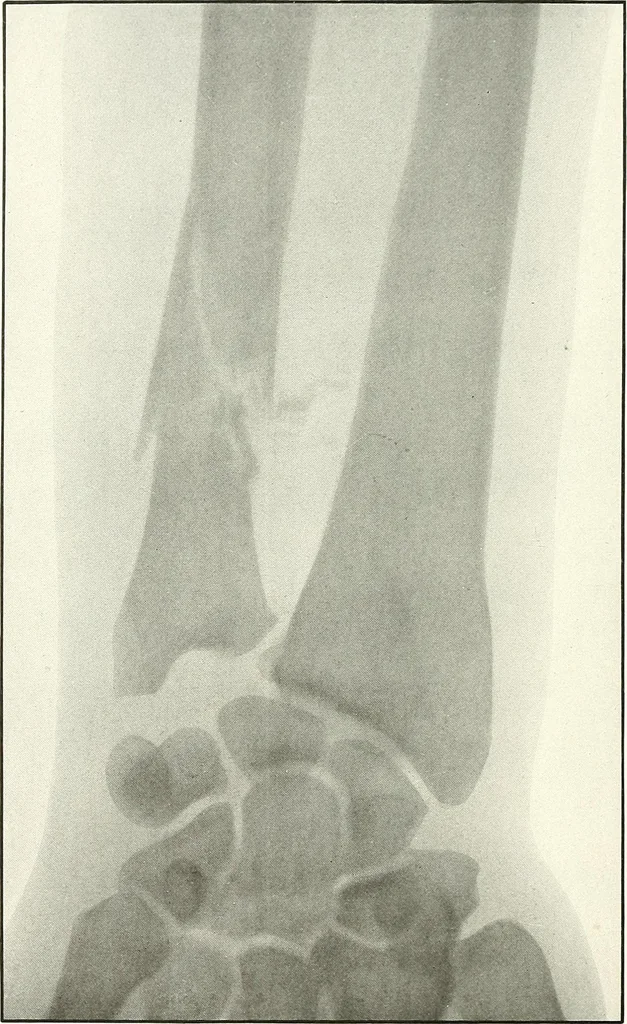 An illustration from Gunshot Roentgenograms : Acollection of Roentgenograms taken in Constantinople during the Turko-Balkan War, 1912-1913, illustrating some gunshot wounds in the Turkish Army, 1916, leaf 94
