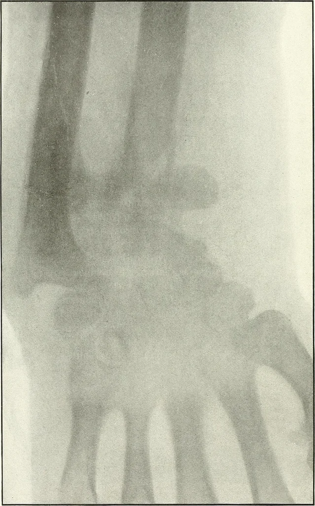An illustration from Gunshot Roentgenograms : Acollection of Roentgenograms taken in Constantinople during the Turko-Balkan War, 1912-1913, illustrating some gunshot wounds in the Turkish Army, 1916, leaf 96