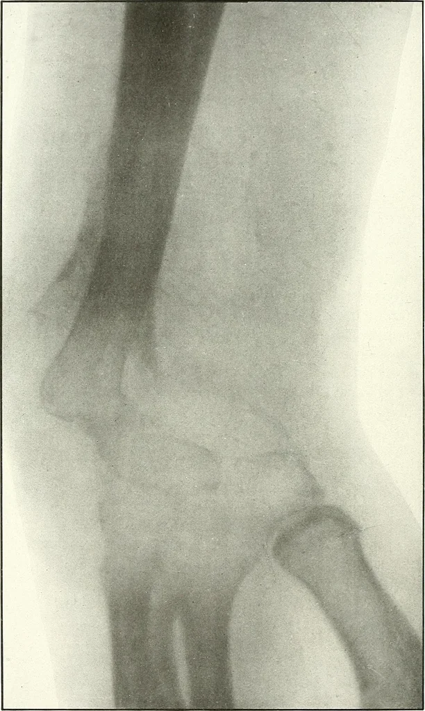 An illustration from Gunshot Roentgenograms : Acollection of Roentgenograms taken in Constantinople during the Turko-Balkan War, 1912-1913, illustrating some gunshot wounds in the Turkish Army, 1916, leaf 98