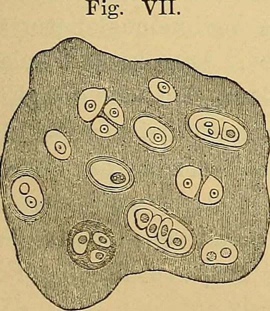 An illustration from Handbuch der klinischen Mikroskopie : mit Berücksichtigung der wichtigsten chemischen Untersuchungen am Krankenbette und der Verwendung des Mikroskopes in der gerichtlichen Medicin, 1883, leaf 88