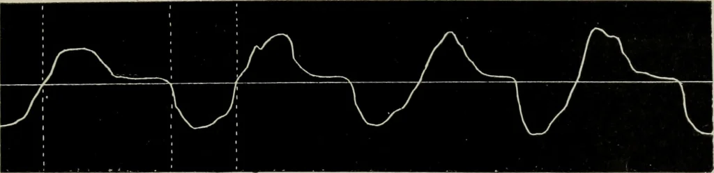 An illustration from The influence of dress in producing the physical decadence of American women : annual address upon obstetrics and gynecology, 1891, leaf 38
