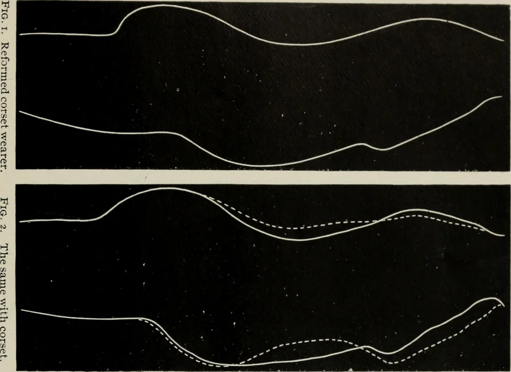 An illustration from The influence of dress in producing the physical decadence of American women : annual address upon obstetrics and gynecology, 1891, leaf 46