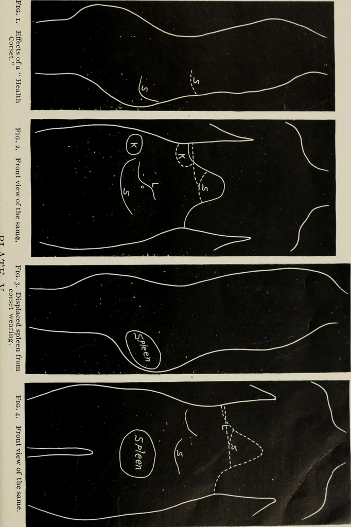 An illustration from The influence of dress in producing the physical decadence of American women : annual address upon obstetrics and gynecology, 1891, leaf 48