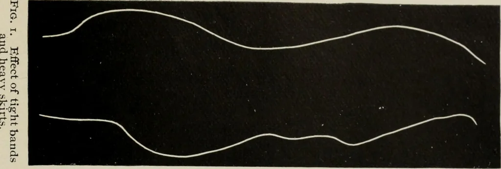 An illustration from The influence of dress in producing the physical decadence of American women : annual address upon obstetrics and gynecology, 1891, leaf 52