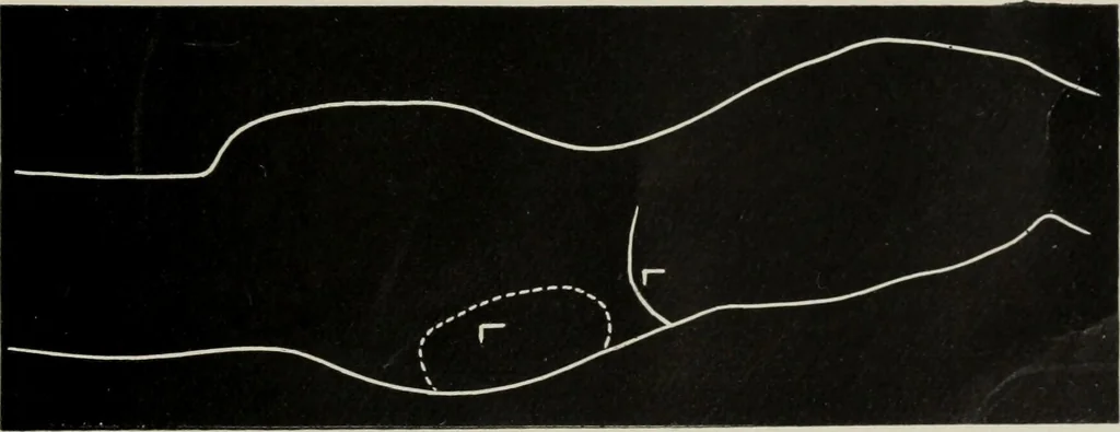 An illustration from The influence of dress in producing the physical decadence of American women : annual address upon obstetrics and gynecology, 1891, leaf 52