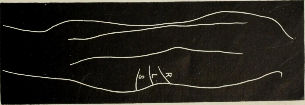 An illustration from The influence of dress in producing the physical decadence of American women : annual address upon obstetrics and gynecology, 1891, leaf 52