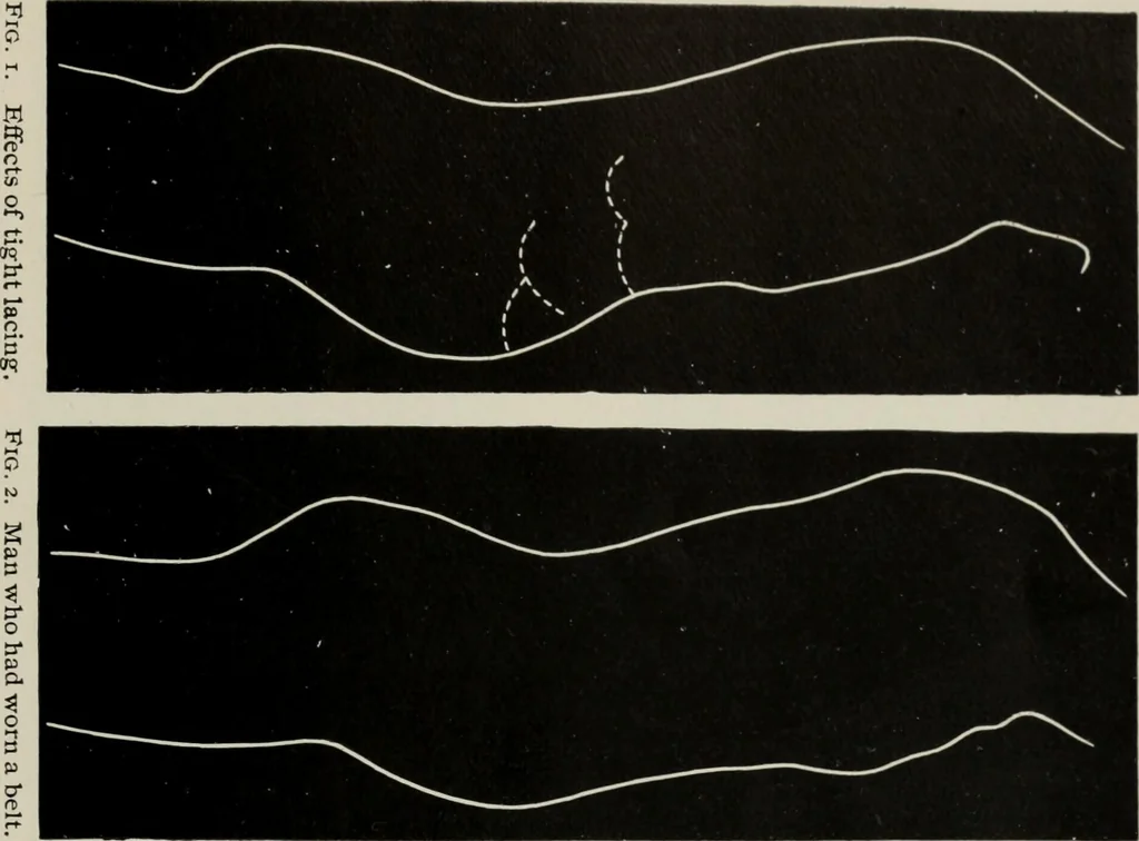 An illustration from The influence of dress in producing the physical decadence of American women : annual address upon obstetrics and gynecology, 1891, leaf 54