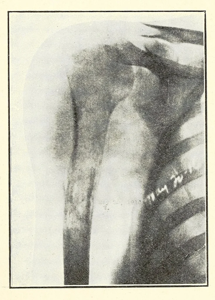 An illustration from The Journal of roentgenology, 1918, leaf 167