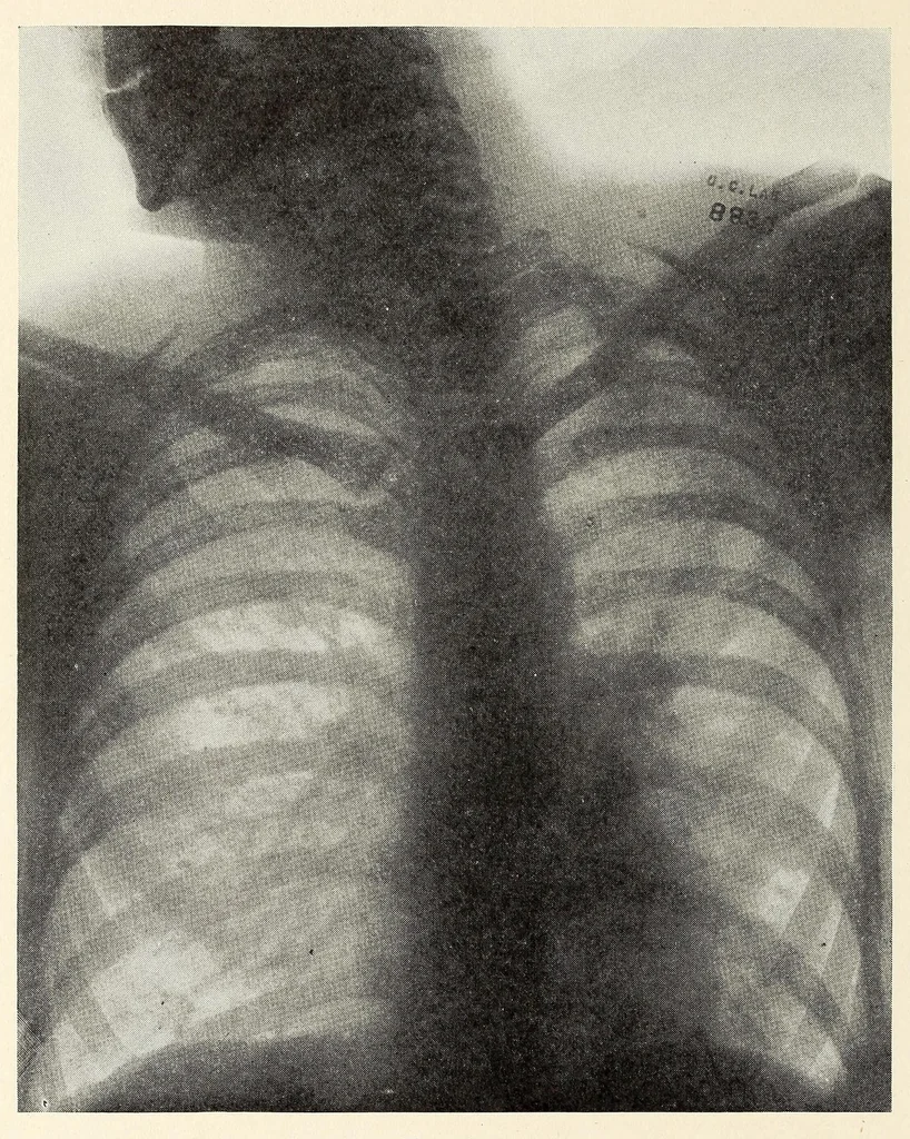 An illustration from The Journal of roentgenology, 1918, leaf 228